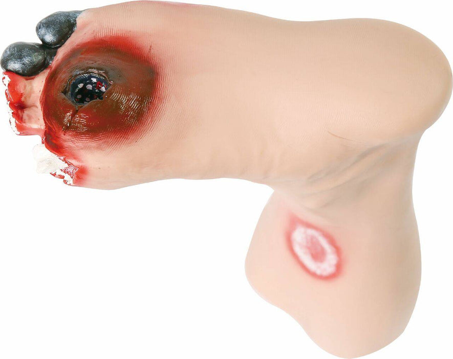 A prosthetic foot displays a large, deep wound and a smaller sore; the foot is positioned against a white background.