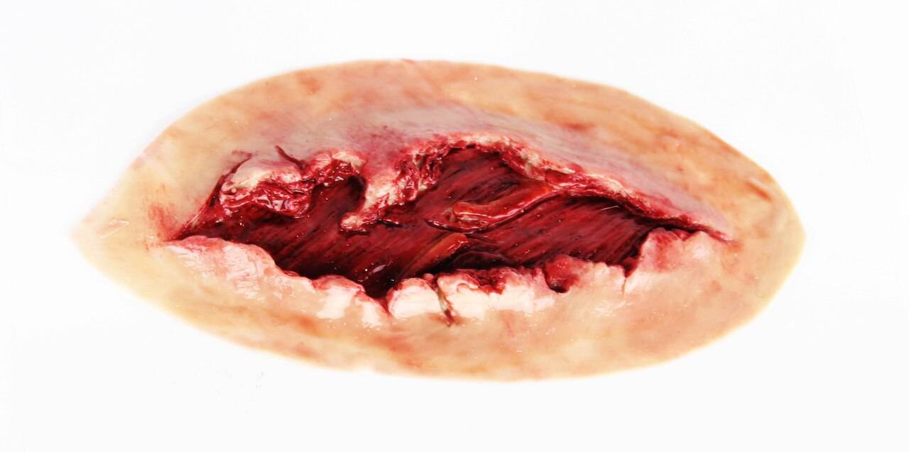 A wound, exhibiting a deep gash revealing exposed flesh and blood, is shown against a white background.