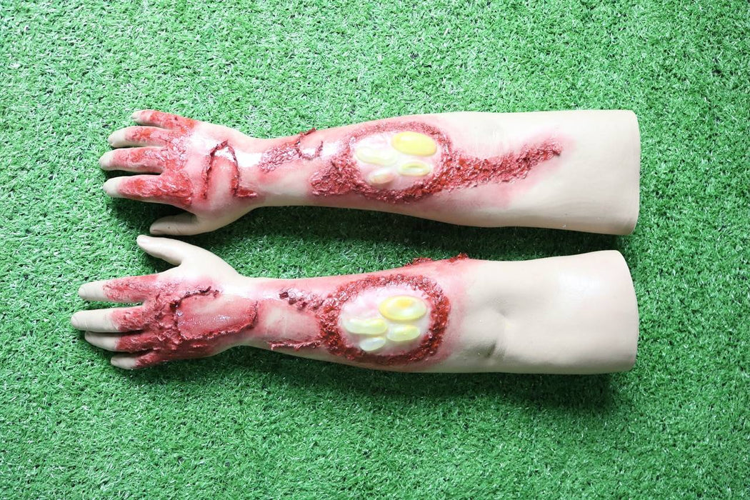 Two artificial arms, displaying simulated burns and blisters, rest on artificial turf.